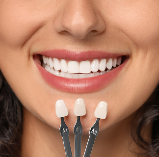 porcelain veneers