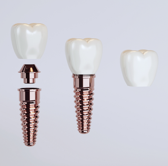 parts of a dental implant