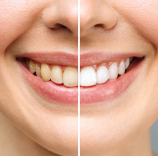 before and after teeth whitening