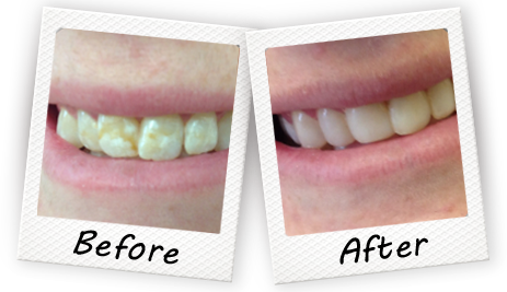 before and after treatment with our Cooper City dentist