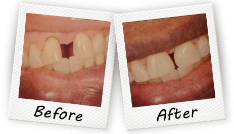 before and after treatment with our Cooper City dentist