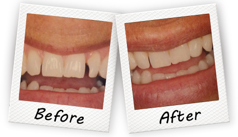 before and after treatment with our Cooper City dentist