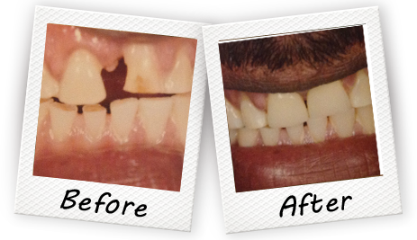 before and after treatment with our Cooper City dentist